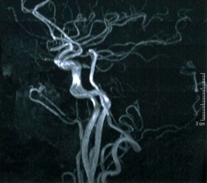 Normal brain. 8. Angiogram - from side