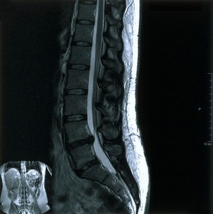 view Bilateral sciatica.