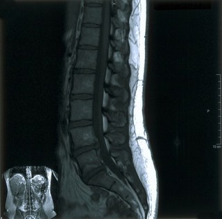 Bilateral sciatica.