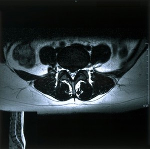 view Bilateral sciatica.