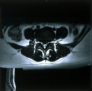 Bilateral sciatica.