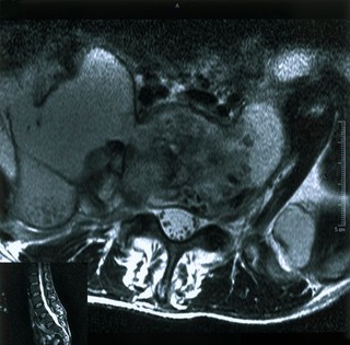 Tuberculous osteomyelitis.