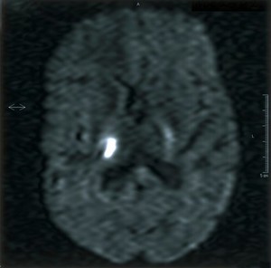 view Right capsular infarct.