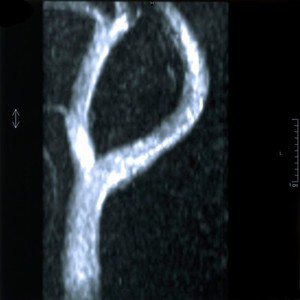 view Right capsular infarct with normal carotid arteries.