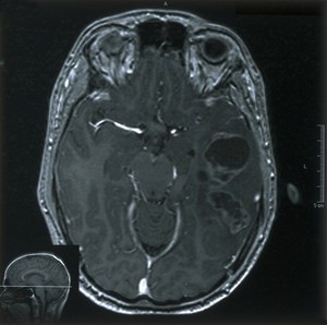 view MRI scan; brain cancer (glioma)