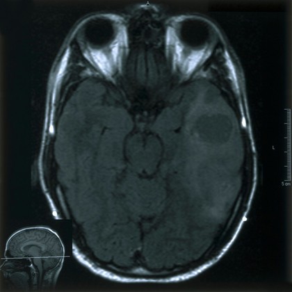 MRI scan; brain cancer (glioma)