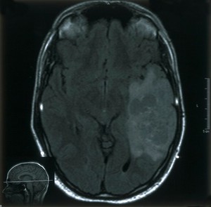 view MRI scan; brain cancer (glioma)