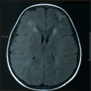 view Moyamoya (puff of smoke) disease.