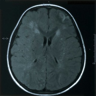 Moyamoya (puff of smoke) disease.