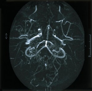 view Moyamoya (puff of smoke) disease.