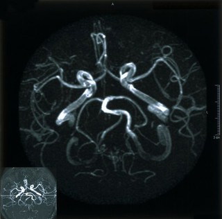 Normal carotid arteries.