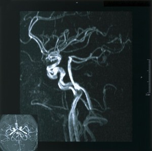 view Normal carotid arteries.Magnetic resonance angiogram (MRA) Intra-cranial, from side of male, aged 38, to show the normal vessels. GOOD.