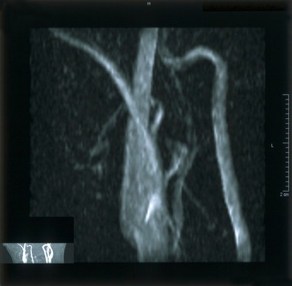 Normal carotid arteries.