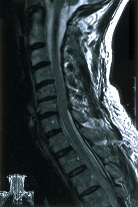 Cavernous haemangiomas of spinal cord.