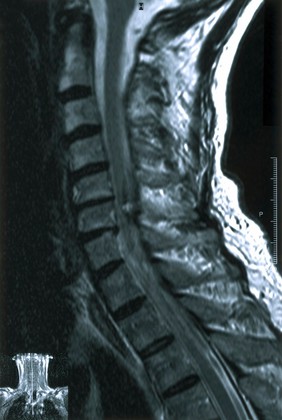 Cavernous haemangiomas of spinal cord.