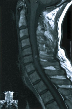 Cavernous haemangiomas of spinal cord.