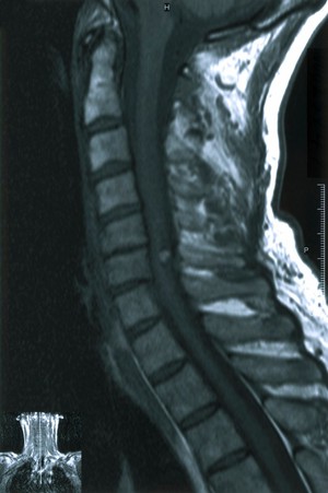 view Cavernous haemangiomas of spinal cord.