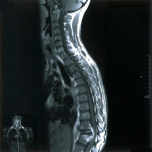 view Tuberculous osteomyelitis with abscesses.