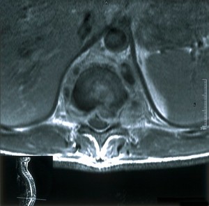 view Tuberculous osteomyelitis with abscesses.