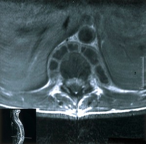 view Tuberculous osteomyelitis with abscesses.