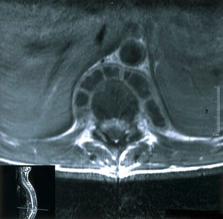 Tuberculous osteomyelitis with abscesses.