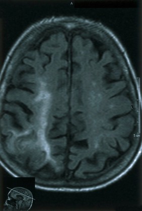 Acute right parietal infarct.