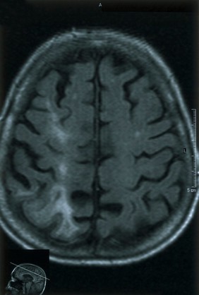 Acute right parietal infarct.