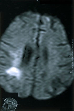 Acute right parietal infarct.