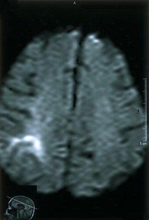 view Acute right parietal infarct.