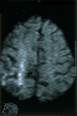 view Acute right parietal infarct.