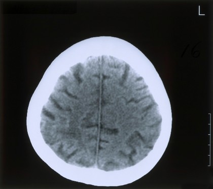 Acute right parietal infarct.