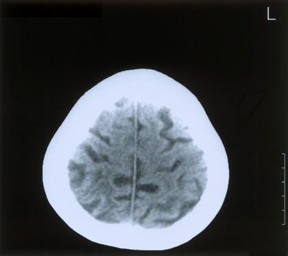 Acute right parietal infarct.