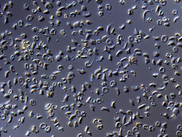Sickled red blood cells