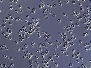 view Red blood cells from a person with sickle cell anaemia. These cells are not sickled as there is plenty of oxygen present. For a deoxygenated, sickled comparison see N0024943