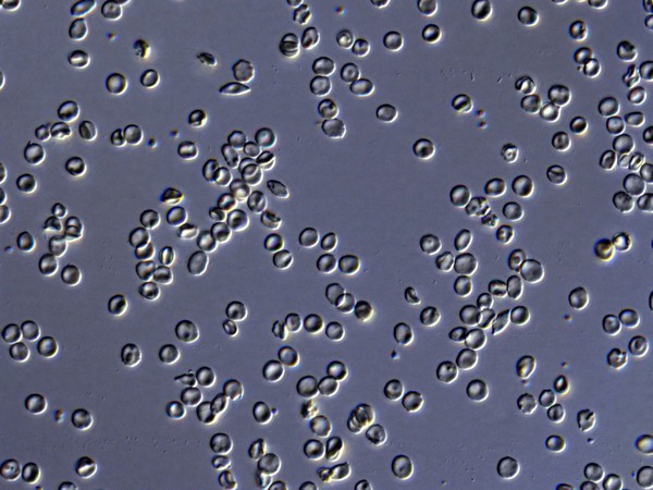 Red blood cells from a person with sickle cell anaemia. These cells are not sickled as there is plenty of oxygen present. For a deoxygenated, sickled comparison see N0024943