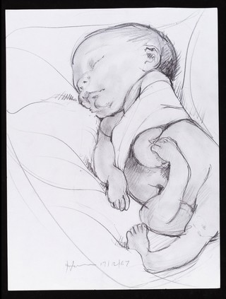 Baby with arthrogryposis. This is caused by a muscle disorder that leads to the joints being limited in their range of movement and the limbs being pulled into abnormal positions.