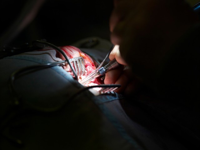 Surgery, UK. Mastoid exploration