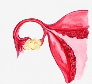 view Right Fallopian tube and ovary