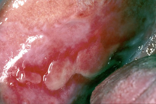 Lichen Planus Buccal Mucosa