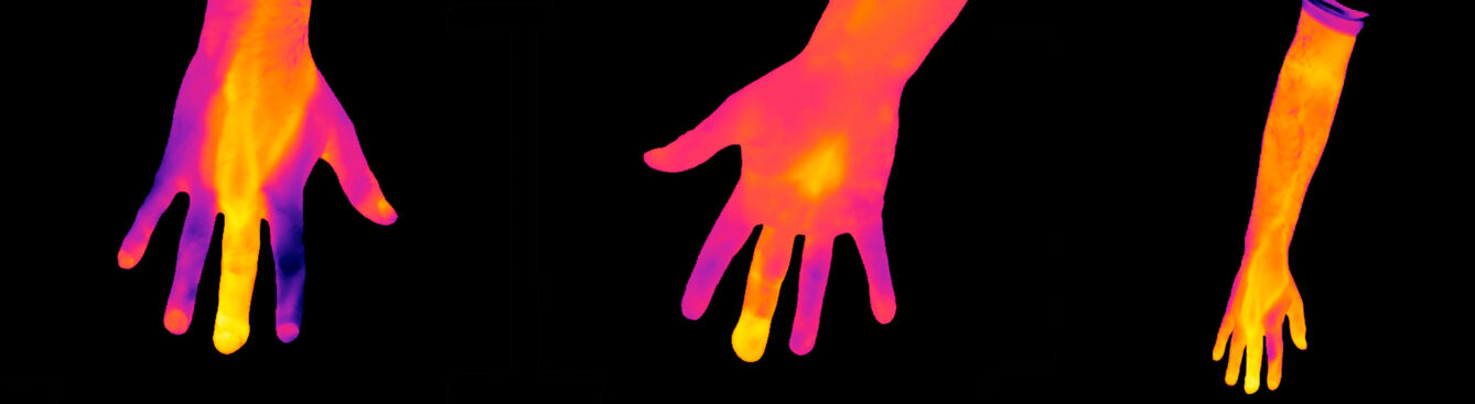 Thermogram of an infected middle finger, left hand.