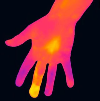 Thermogram of an infected middle finger, left hand.