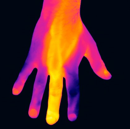 Thermogram of an infected middle finger, left hand.
