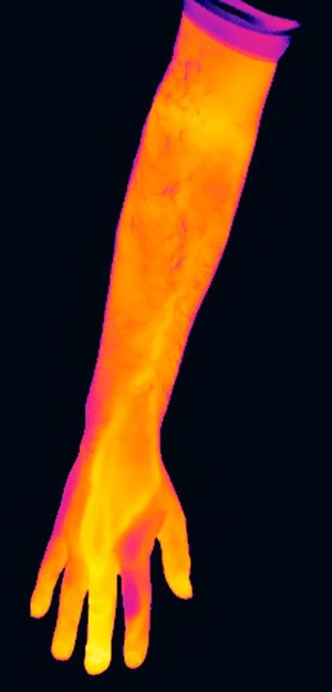 view Thermogram of an infected middle finger, left hand.