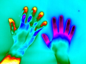 view Raynaud's Phenomenon