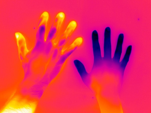 Raynaud's Phenomenon