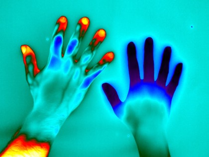 Raynaud's Phenomenon