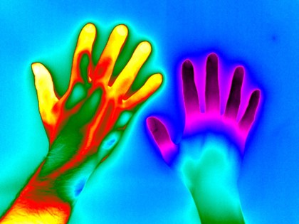 Raynaud's Phenomenon