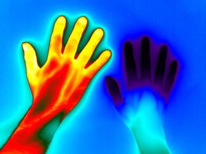 view Raynaud's Phenomenon