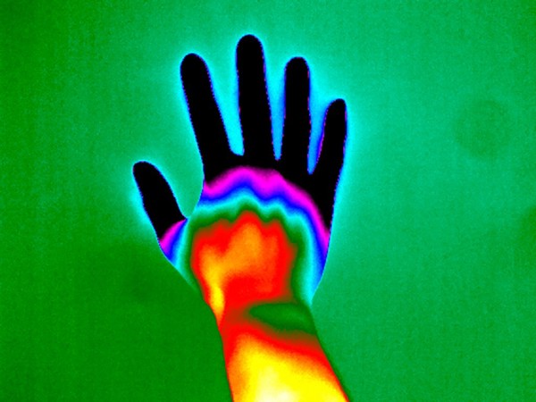 Raynaud's Phenomenon