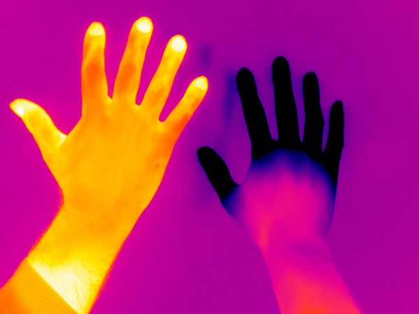 Raynaud's Phenomenon